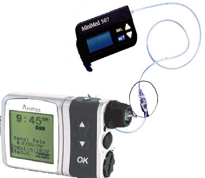 Figure 1b: Two insulin pumps