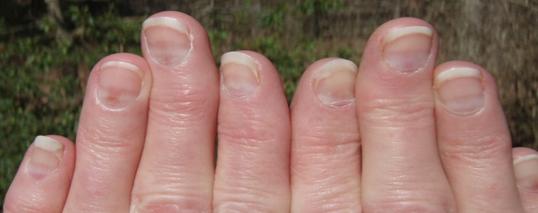 lines in fingernails