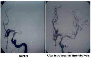 Acute Stroke Thrombolysis