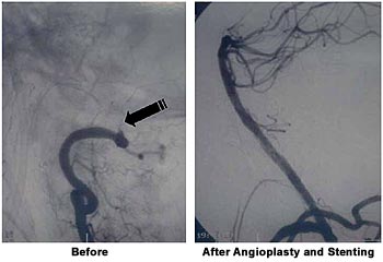 Acute Stroke Angioplasty and Stenting.