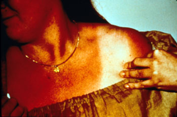 Sunburn></div>
<br><br>
Second-degree burns are wet, red and very painful. Blisters usually form.
<br><br>
<div class=